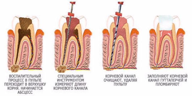 лечение зуба
