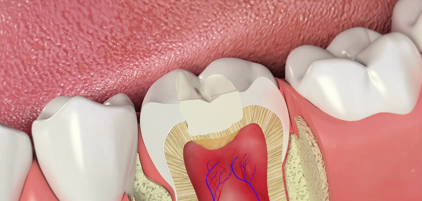 Зуб реагирует на горячее после удаления нерва