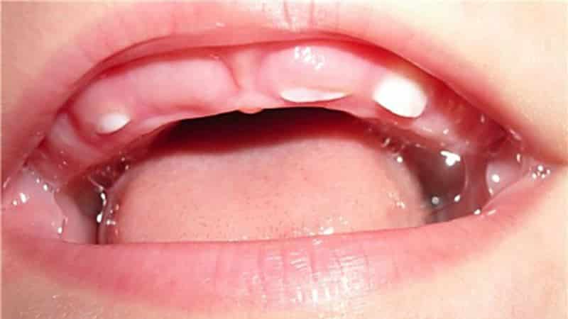 зубы в 1 год