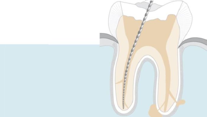 Депульпирование зуба перед протезированием