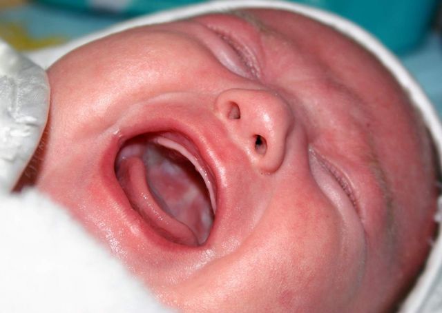 Лечение молочницы у новорожденных во рту