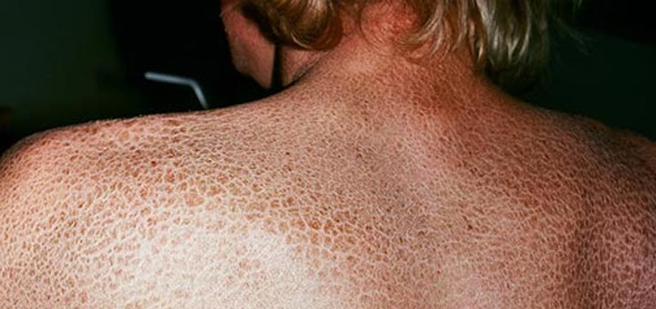При каких заболеваниях кожи нужно выбирать уходовые средства с мочевиной? Полный список