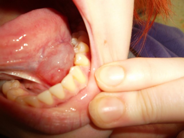 Под языком белая болячка лечение