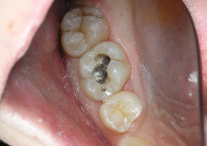По каким причинам зуб реагирует на холодное после пломбирования?