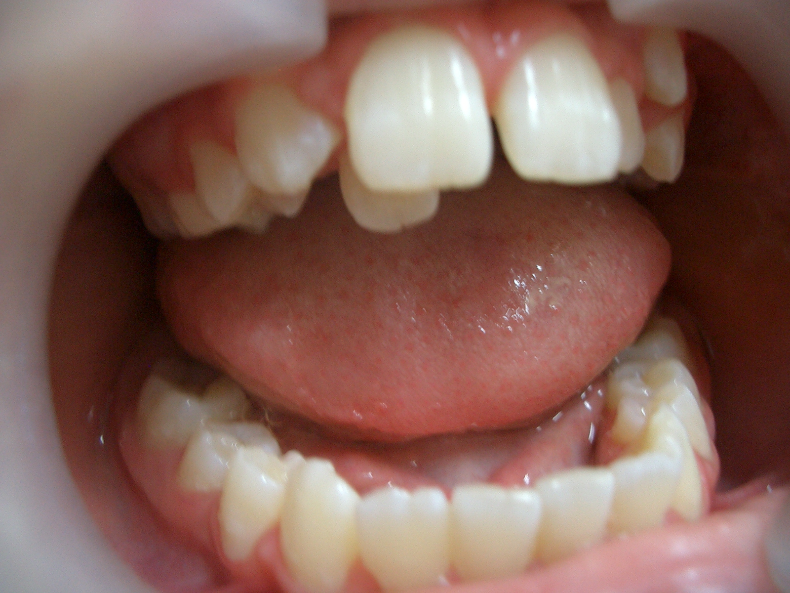 Что такое ретинированные и дистопированные зубы?