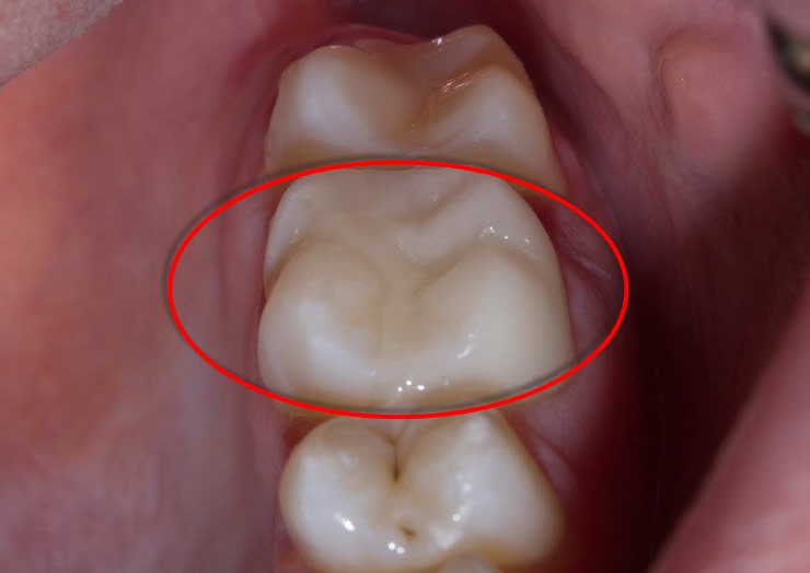 Больно ли ставить пломбу на зуб