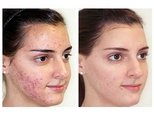 Эффект клиндовита на кожу