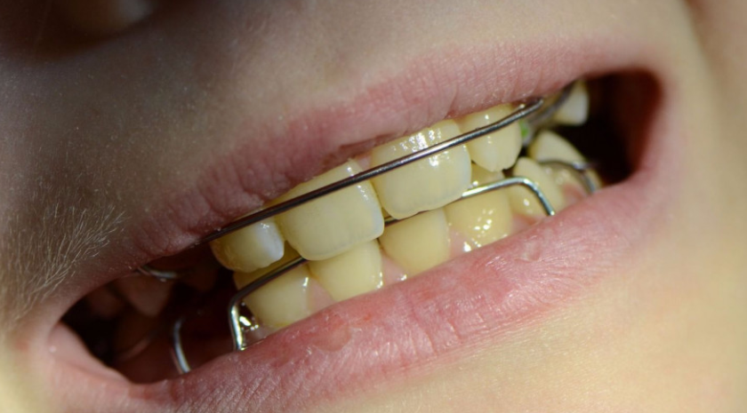 Пластина на зубы для детей фото