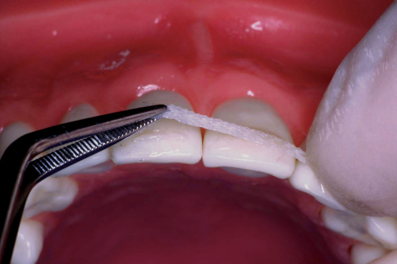 Шинирование зубов: что это такое