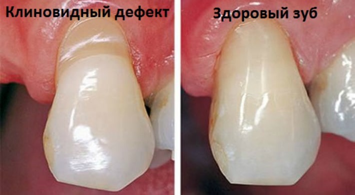 дефект зубов