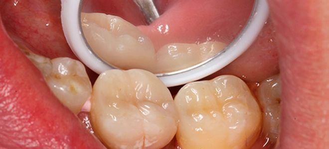 Почему болит зуб после пломбирования при накусывании?