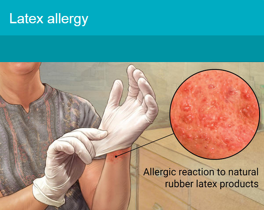 аллергия на латекс, медицинские перчатки