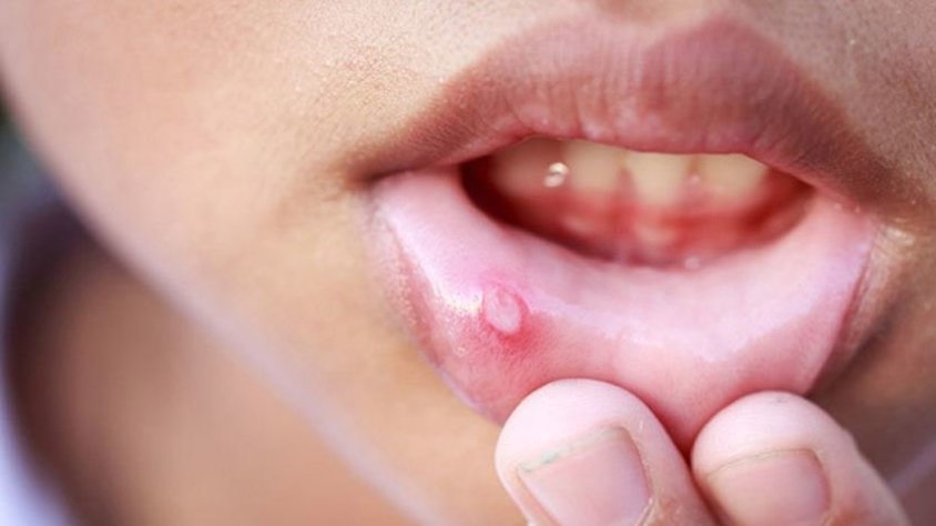 Болячки на губах у ребенка