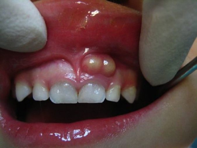 Уплотнения и шишки на деснах после удаления зуба
