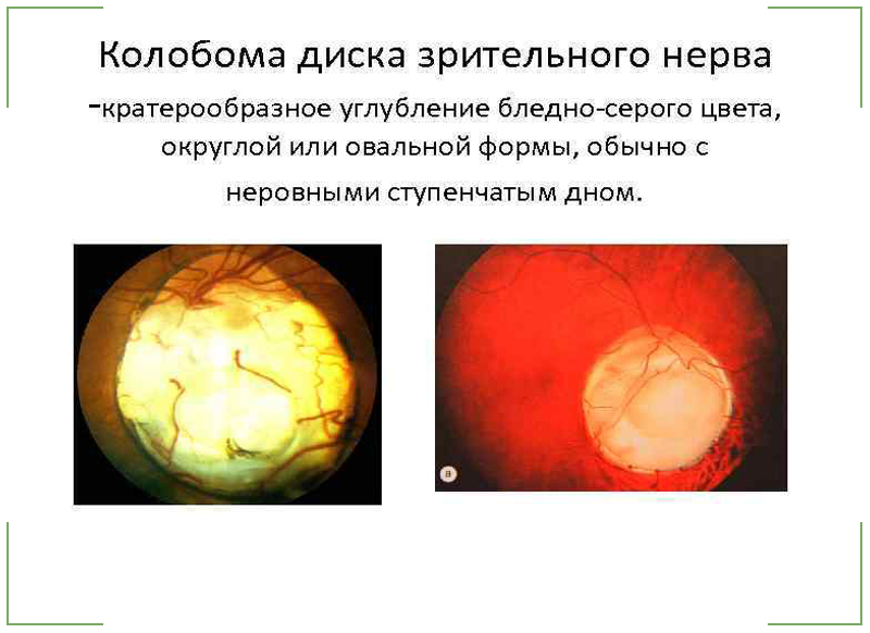 Аномалия развития зрительного нерва. Колобома ДЗН левого глаза,. Бледный ДЗН что это значит форум.