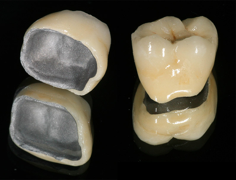 Коронка на зуб
