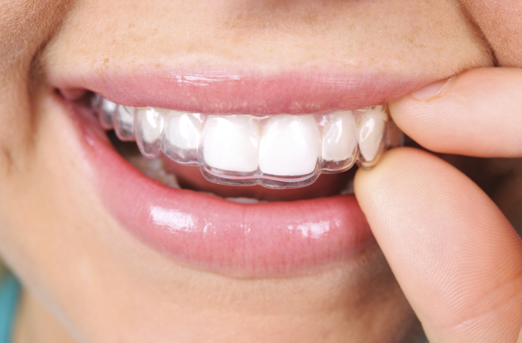 Что из себя представляют трейнеры для зубов?