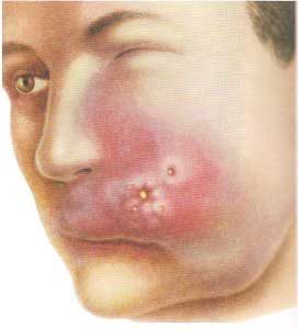 Последствия фурункула на лице