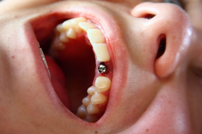 Что делать после имплантации зубов, как ухаживать и питаться. Важные рекомендации