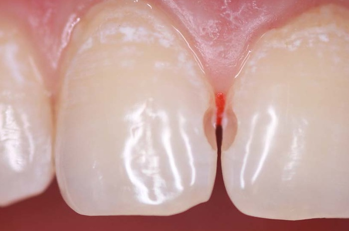Что делать при появлении кариеса между зубами?