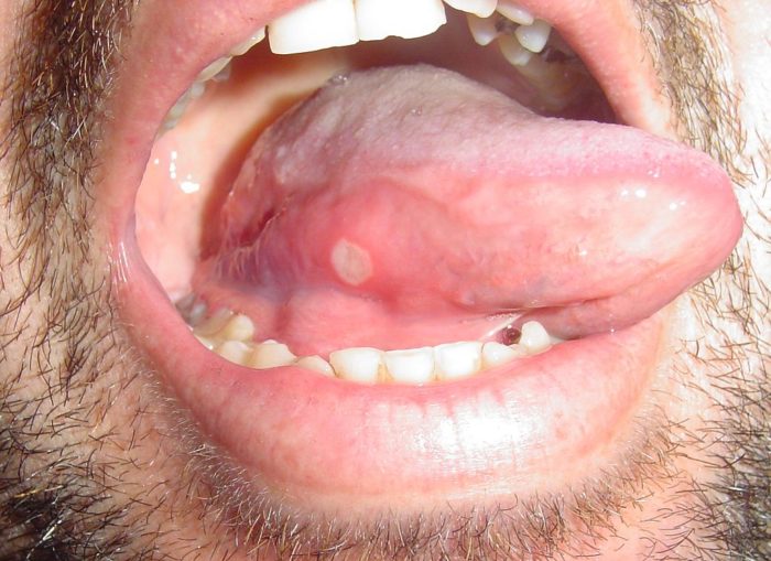 Почему под языком появляются болячки и язвочки?