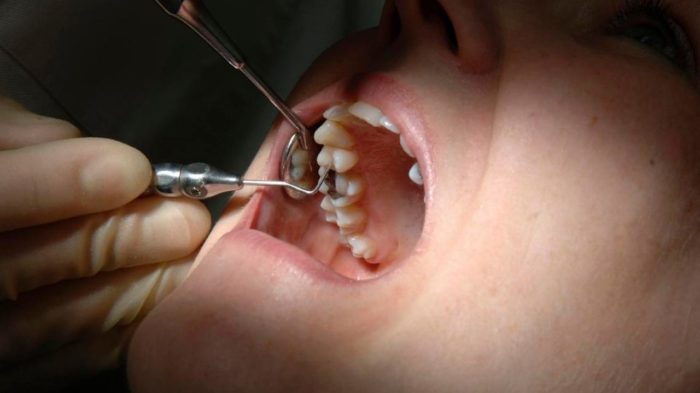 Болит зуб при надавливании после пломбирования