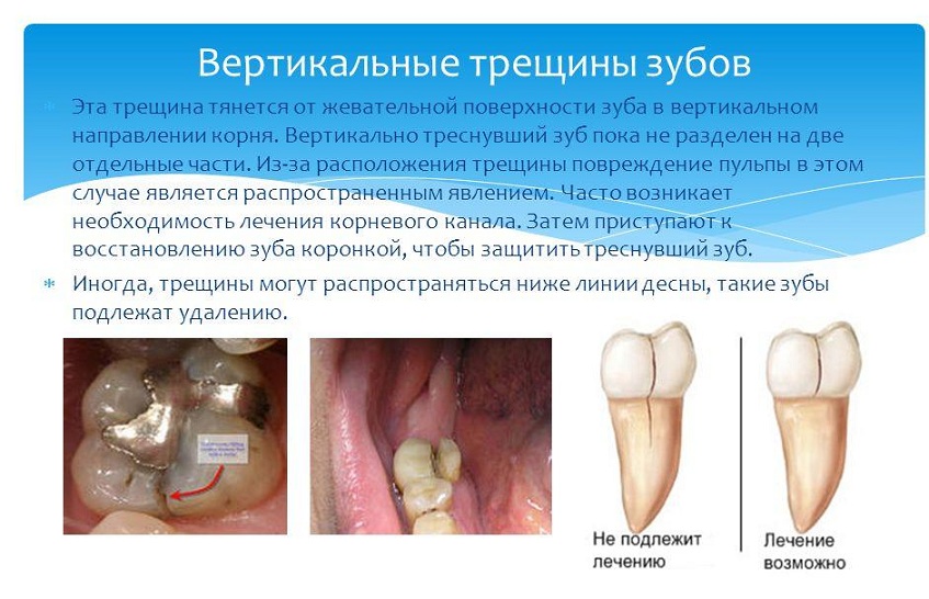 трещина зуба