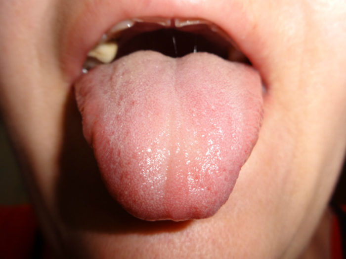Что делать, если болит кончик языка?