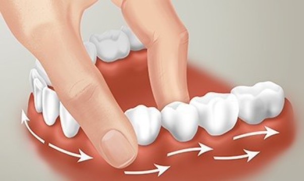 Восстановление зубной эмали