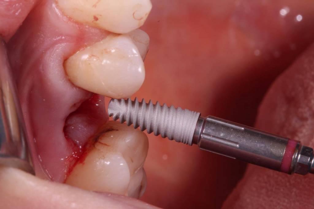 Осложнения после удаления зубов