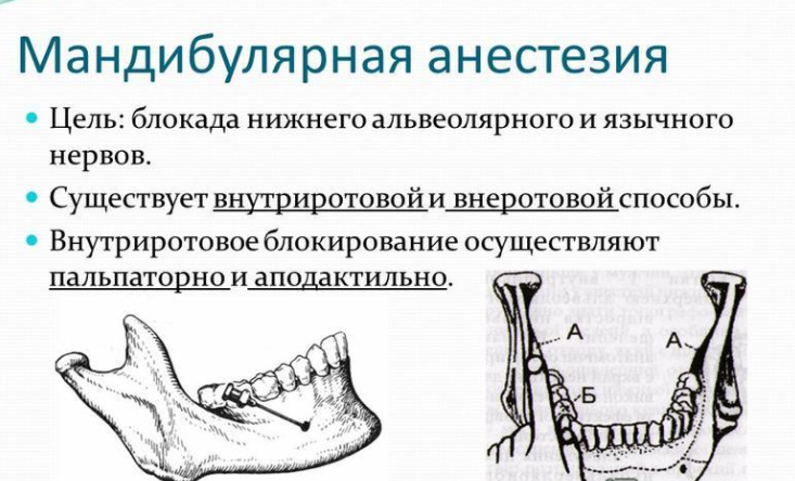 Мандибулярная анестезия в стоматологии схема проведения видео