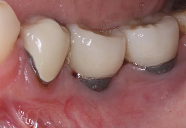 Как снять отек после имплантации зубов?