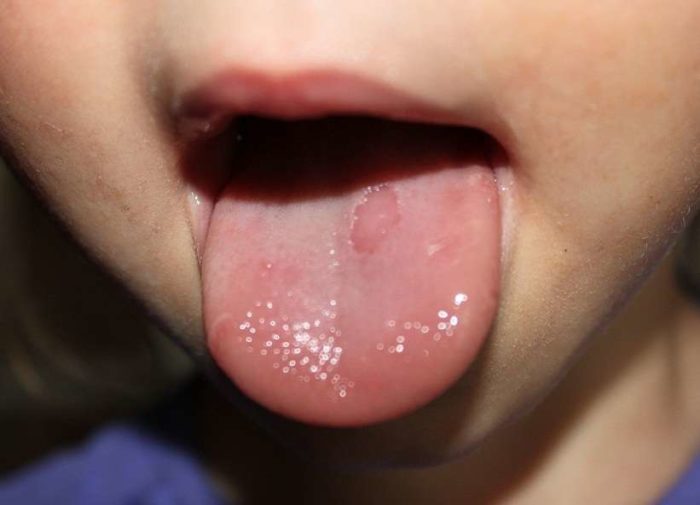 У ребенка болит язык