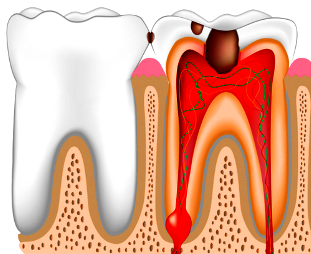 Зуб с удаленным нервом