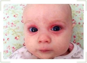 Красные пятна под глазами у ребенка