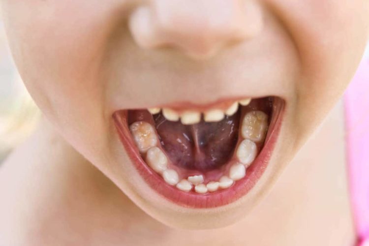 У ребенка растут зубы вторым рядом
