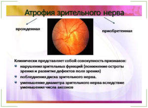 Атрофия зрительного нерва