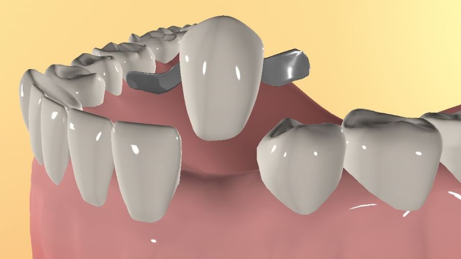 Особенности протезирования без обточки зубов