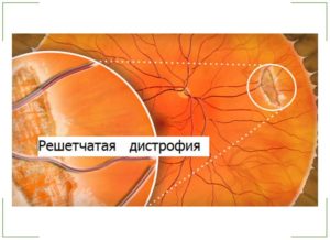 Периферическая дистрофия сетчатки глаза