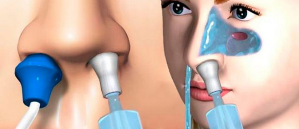 Иллюстрация промывания носа методом перемещения жидкости по Проетцу (кукушка)