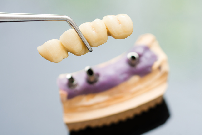 Мостовидные несъемные зубные протезы