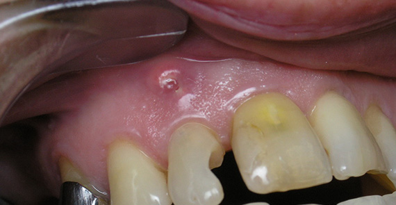 Кистогранулема зуба