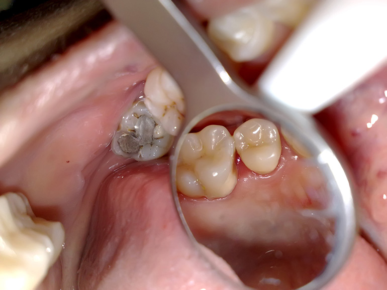 Воспаление зубного нерва