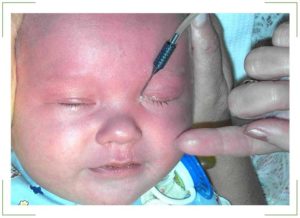 Массаж слезного канала у новорожденного