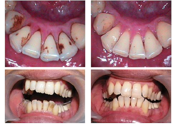 зубы после чистки