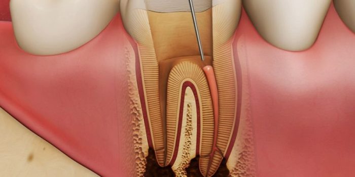 Удаление пульпы зуба
