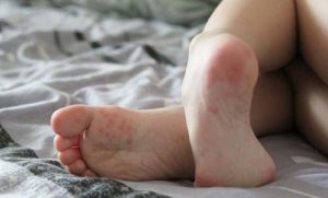 Потница на ногах у ребенка