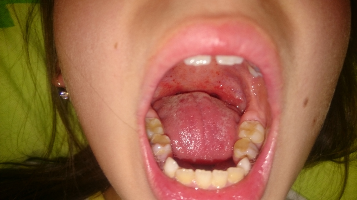 Болит небо во рту: причины и лечение
