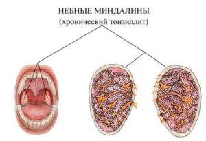 Небные миндалины при хроническом тонзиллите