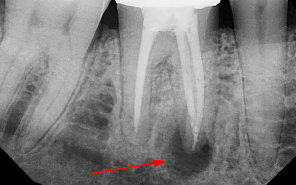 Воспаление зуба: причины, симптомы, методы лечения